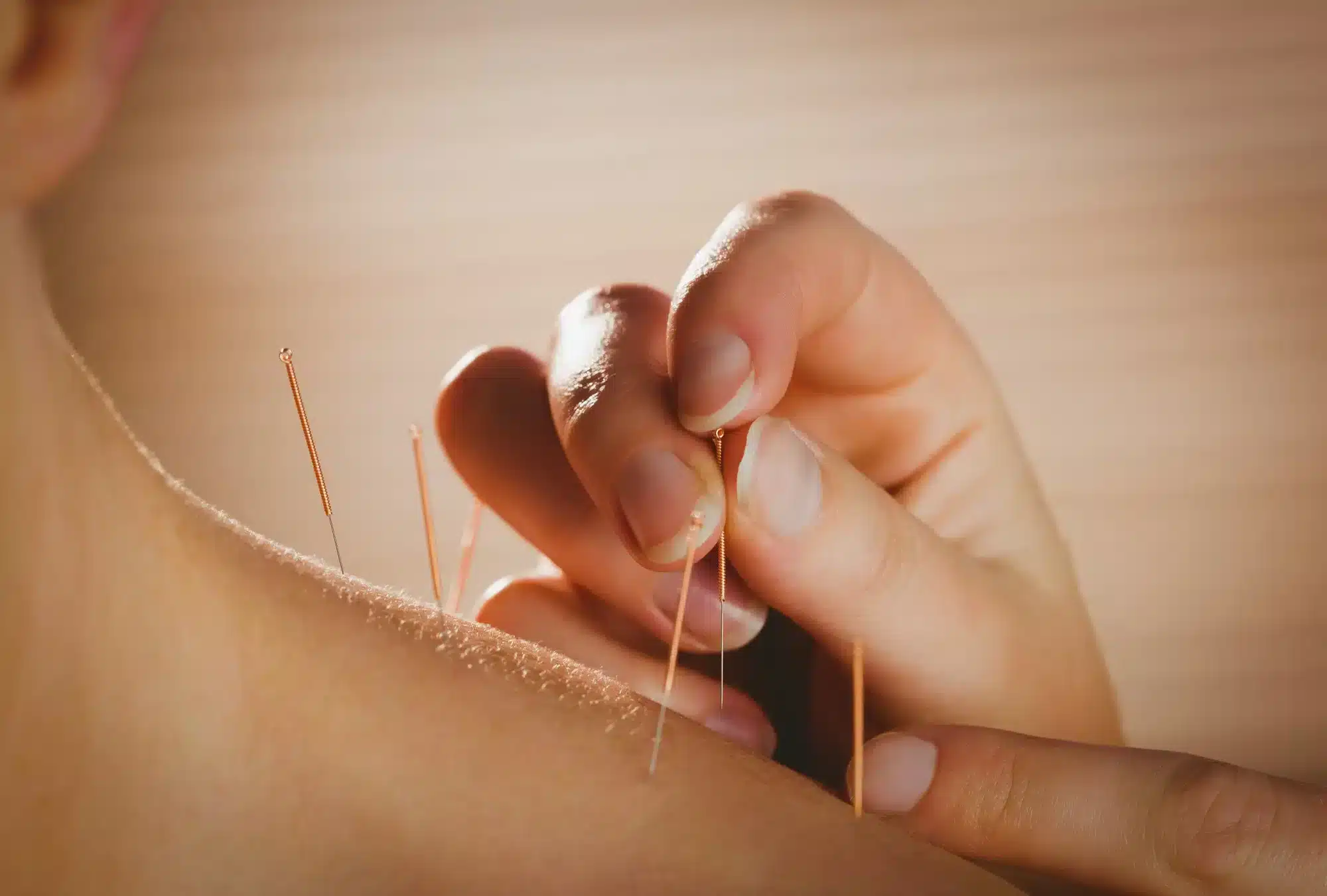 young-woman-getting-acupuncture-treatment