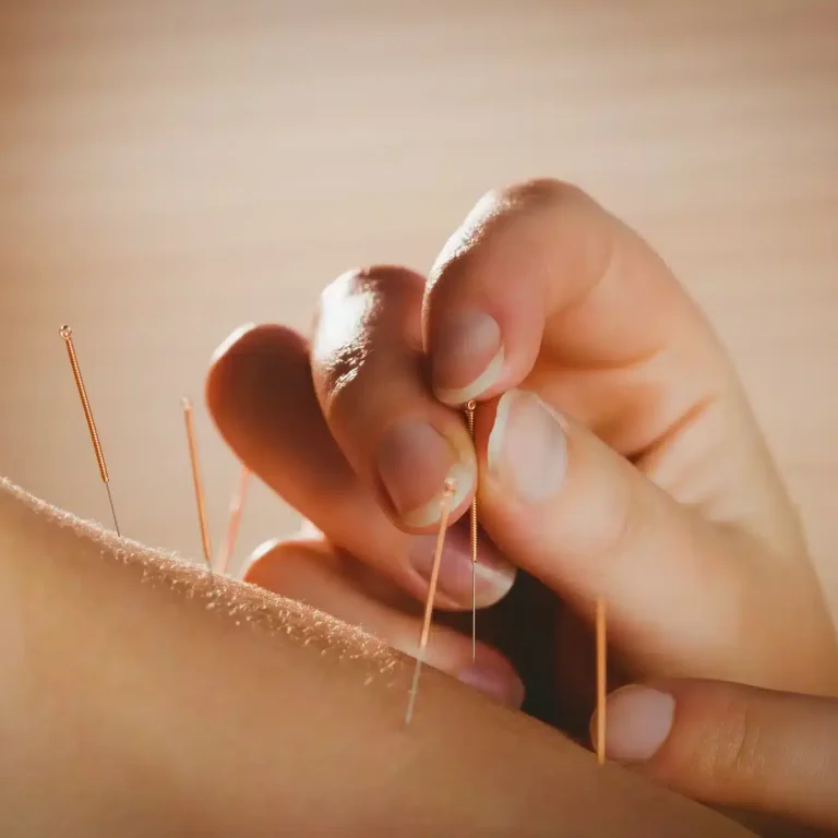 young-woman-getting-acupuncture-treatment
